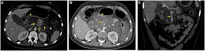 Case Report: Splanchnic Vein Thrombosis as a Complication of Necrotizing Acute Pancreatitis in a Pediatric Patient